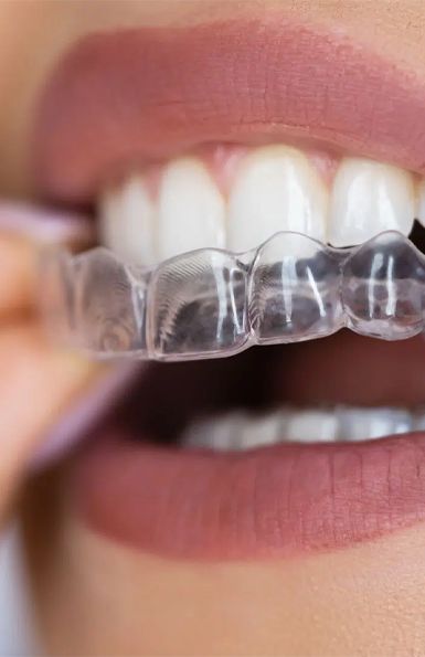 Primer plano de una sonrisa con un alineador invisible
